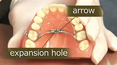 Palatal Expanders | Spillers Orthodontics