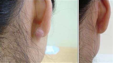 Keloid on ear: Causes, treatment, and prevention
