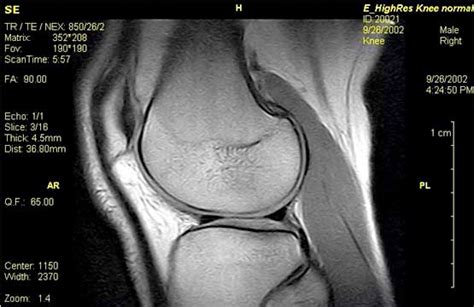 Ex-Scan UK MRI Scan Knees