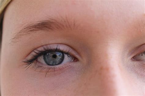 Eye Bag Surgery: Risks, Complications, and Side-Effects - London Facial Plastic Surgeon Facelift ...