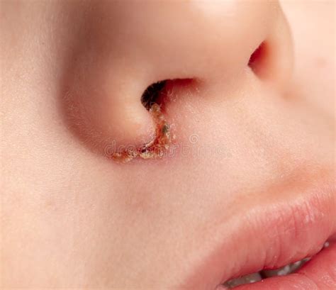 Infection on the Nose of the Child Stock Image - Image of treatment, dermatology: 141084509