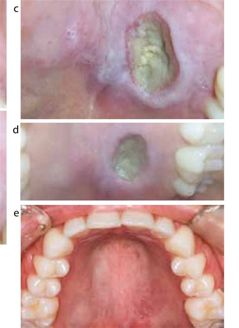 Figure 1 from Necrotizing sialometaplasia – a diagnostic conundrum ...