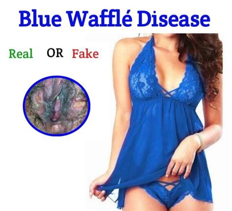 Blue Wafflé Disease: WebMD Separates Facts From Fiction (Pictures) - Public Health