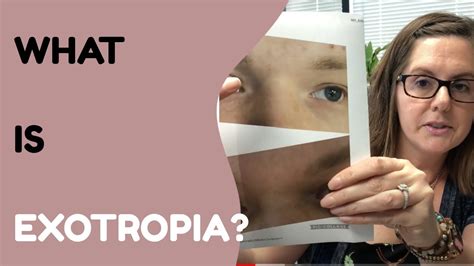 What Is Exotropia And How Do We Treat It? - YouTube