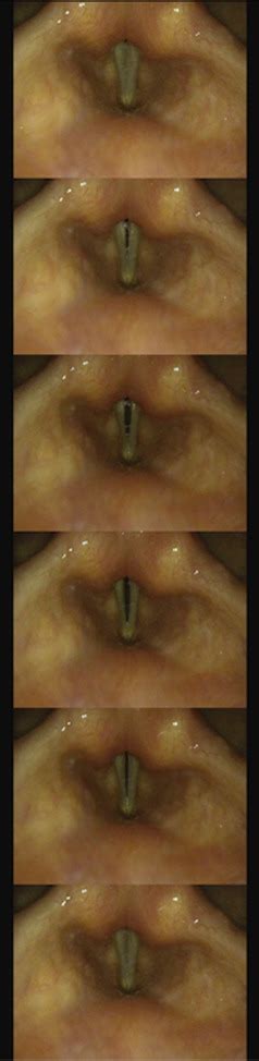 Managing Otolaryngologic Complications in Cardiothoracic Surgery - The Annals of Thoracic Surgery