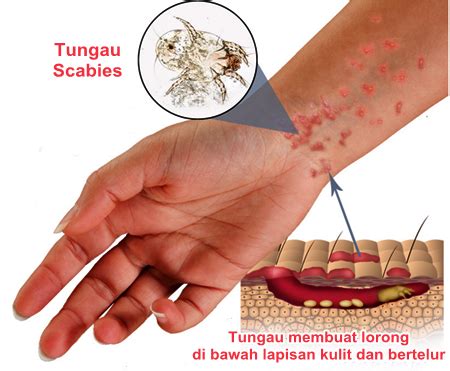 Cara Menyembuhkan Penyakit Kulit Kudis, Gudik, Scabies Secara Alami ...