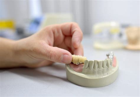 How To Care For Your Dental Bridge