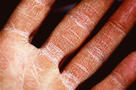 Mayo Clinic Minute: Eczema occurs in people of all ages