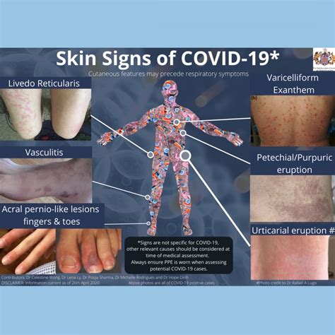 Skin Signs of COVID-19 - Chroma Dermatology