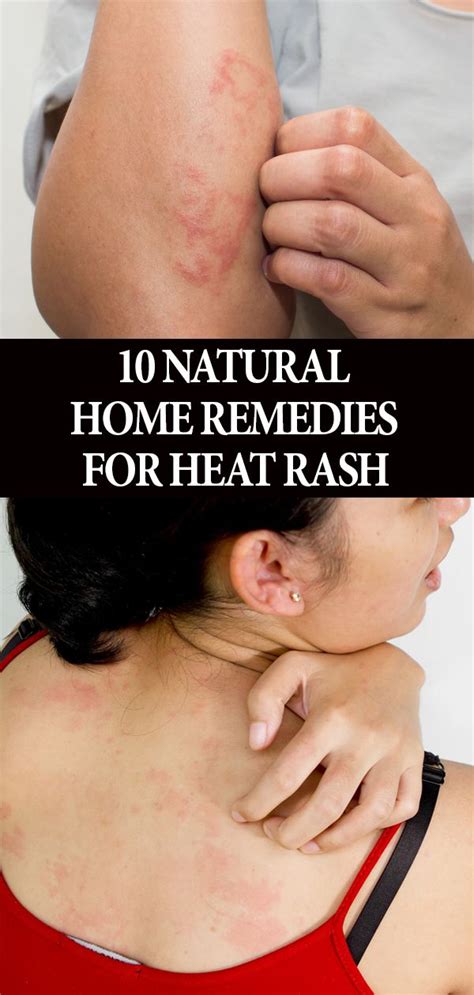 10 Natural Home Remedies For Heat Rash + Prevention Tips in 2020 | Heat rash, Home remedies for ...