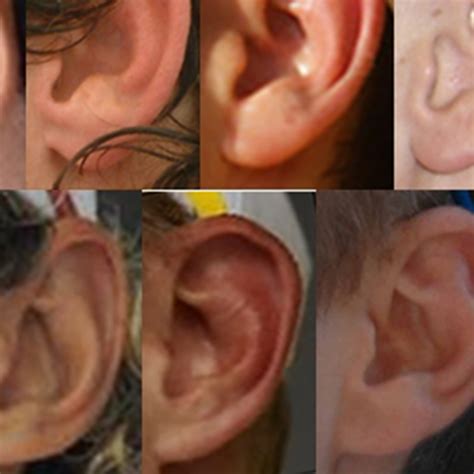 Unattached Earlobes Dominant Or Recessive