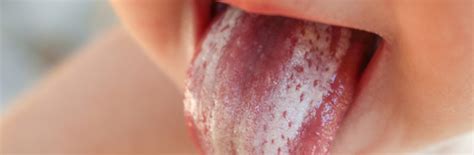 Oral Thrush Symptoms, Causes and Treatments Explained | Nature's Best