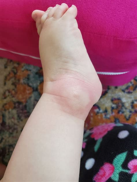 Mosquito bite. Normal reaction or room for concern? | BabyCenter