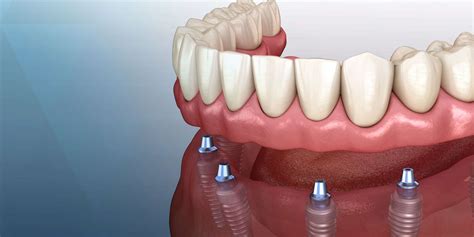 Multiple Missing Teeth | Florence, SC | Bela Family Dentistry