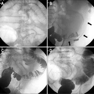 Photographs of two colonic stents with retrieval systems consisting of... | Download Scientific ...