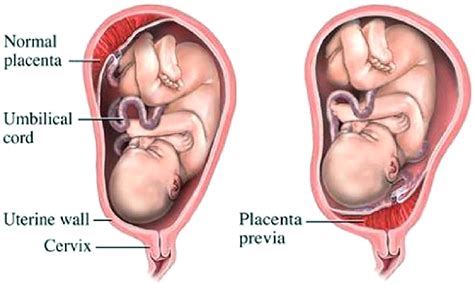 Schematic diagram of the normal location of the placenta and of... | Download Scientific Diagram