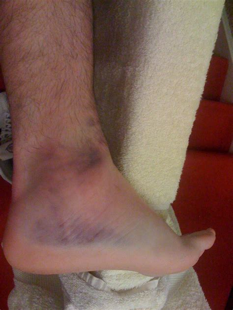 Ankle swell and internal bleeding | Ankle swell and internal… | Flickr