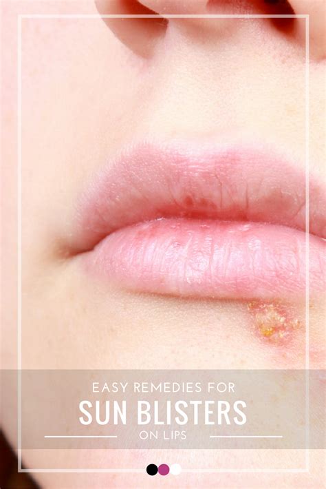 Here's how to tackle sun blisters on lips! | Sun blisters, Blister on ...