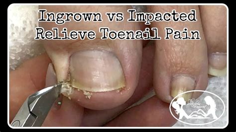 Ingrown Toenail and Impacted Toenail Relief and Prevention PedicureTutorial - YouTube