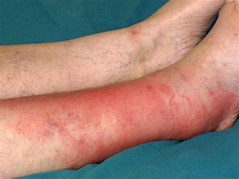 Cellulitis: Signs and Symptoms