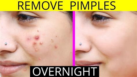 How To Lose A Pimple Overnight - Internaljapan9