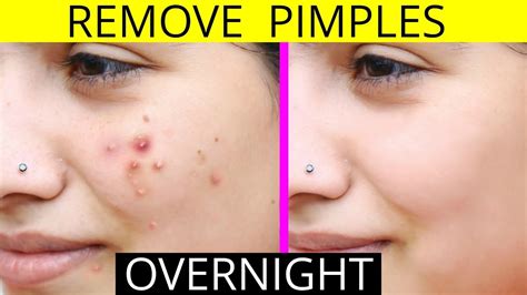 Pimples On Face Removal Tips