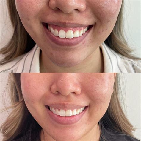 Lip Flip VS Lip Filler | Before and After | The Aesthetic Method Ferndale, MI