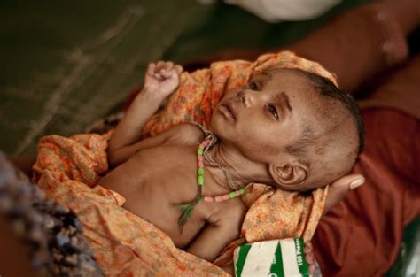 Child Malnutrition - The Global Citizen