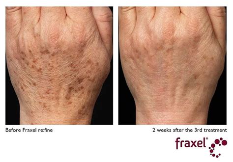 Fraxel laser for scars, spots and stretch marks