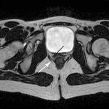 MRI Anatomy of the Anorectal Region | Radiology Key