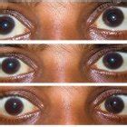 Eye movements. Bilateral symmetrical near complete ophthalmoplegia. | Download Scientific Diagram