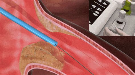 Angiography - Dr. Sarita Rao