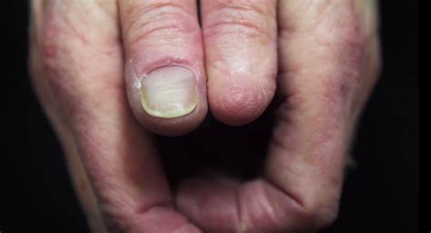 Doctors warn about skin cancer under fingernails