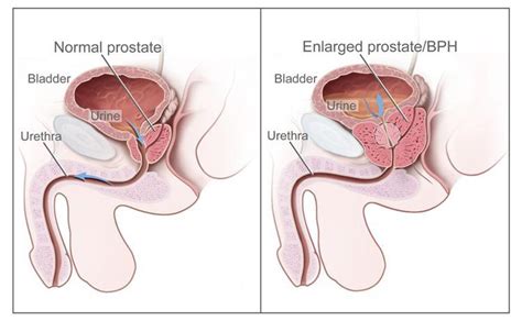 Understanding Prostate Changes - NCI