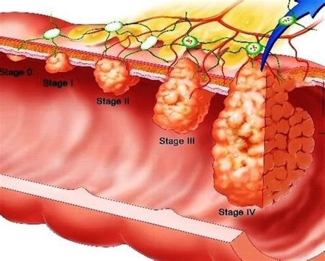 stages of colon cancer | Anatomy System - Human Body Anatomy diagram ...