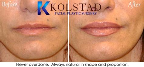 Lip Augmentation Before & After Gallery | Dr. Kolstad - San Diego Facial Plastic Surgeon