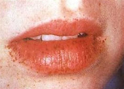 Black Spots on Lips - Pictures, Causes, Treatment, Remedies