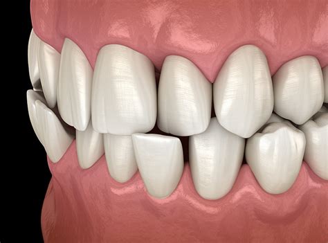 Crossbite: Causes, Symptoms & How is it Treated? « Smile Team ...