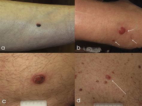 Nodular Malignant Melanoma