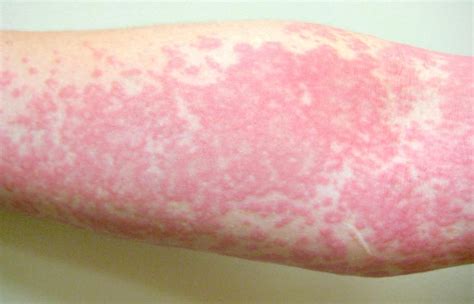 Chlorine Rash: Symptoms, Treatment, Prevention