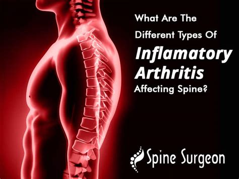 What Are The Different Types Of Inflammatory Arthritis Affecting Spine ...