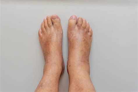 Simple Info About How To Relieve A Swollen Ankle - Strangertourist2