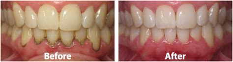 How Often To Scale And Polish Teeth - Teeth Poster