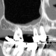 Single Stage Graft & Implant | Single Stage Graft & Implant - Kazemi Oral Surgery | Facialart.com