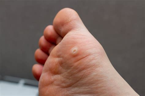 Large Wart On Bottom Of Foot Shop | emergencydentistry.com