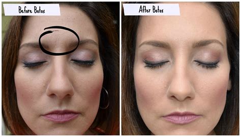 Botox before and after photos from Pretty Proof #BeautyTipsForDarkCircles #MascaraTips # ...