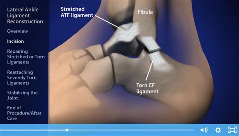 Lateral Ankle Ligament Reconstruction [ALR] - Foot & Ankle Center of Arizona