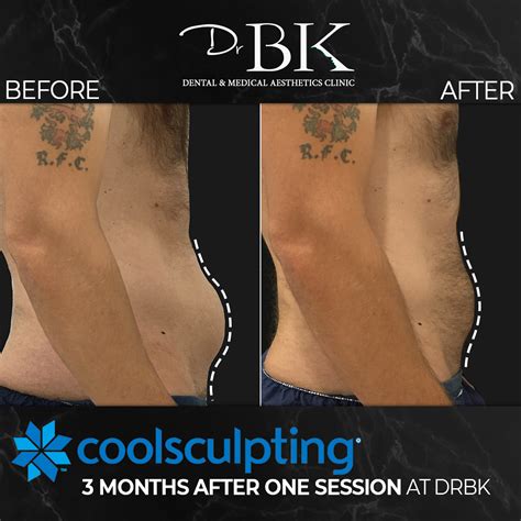 Coolsculpting® Fat Freezing Treatment - DrBK Clinic in Reading