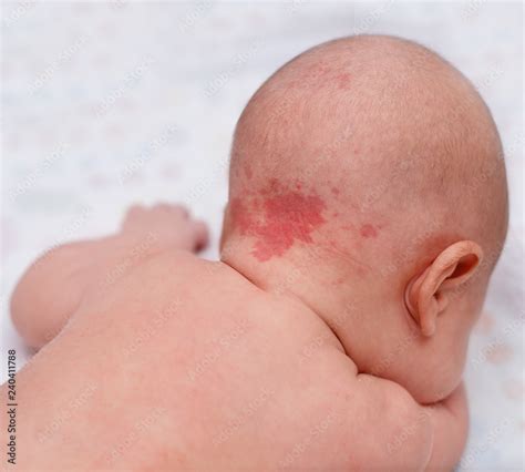 Hemangioma, benign tumor on the back of the head in an infant. Stock ...