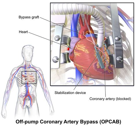 Heart Surgery Types - Open, Bypass, Ablation, Heart Valve surgery